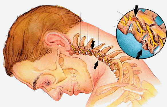 Stadi di osteocondosi della colonna cervicale